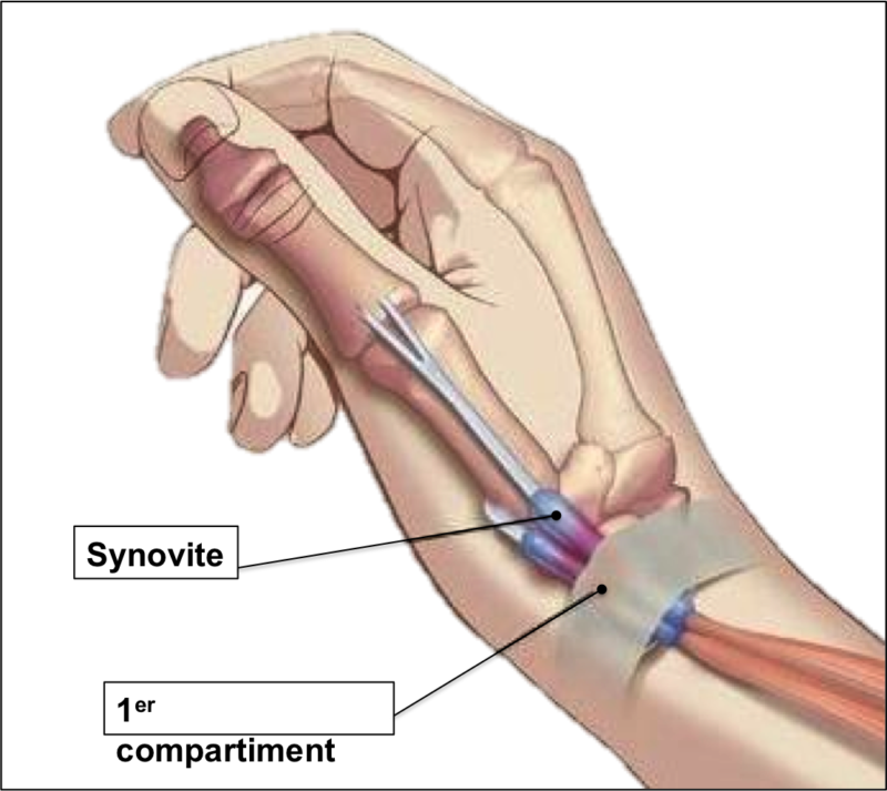 Синдром де кервена лечение. Тендовагинит де Кервена кисти. Болезнь де Кервена операция. Тендовагинит лучезапястного. Болезнь де Кервена тендовагинит.
