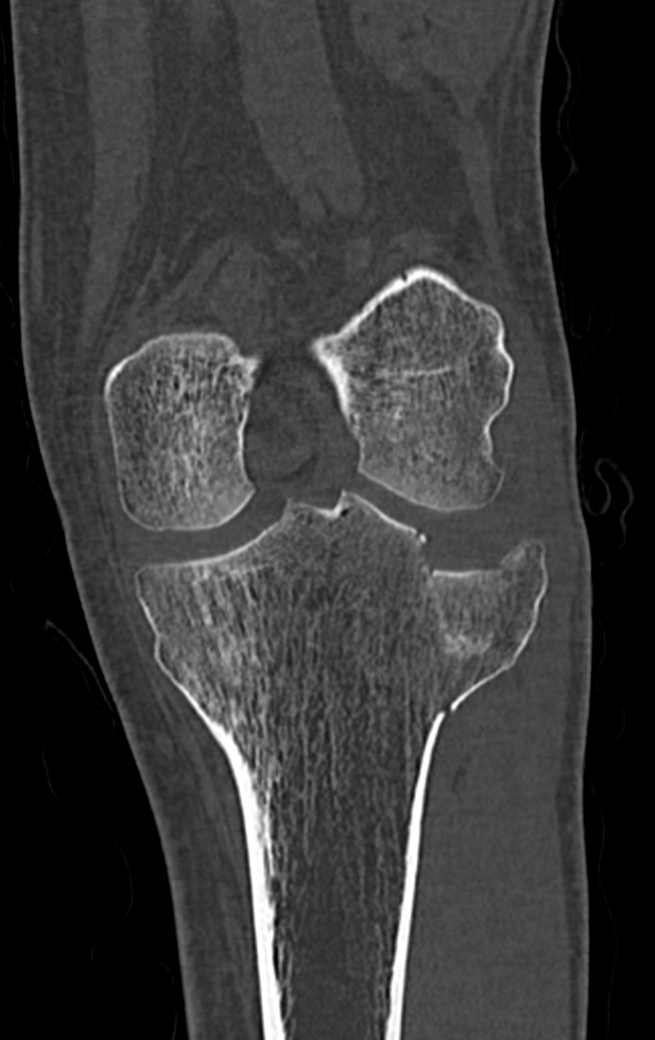 Quest Ce Quune Fracture Du Plateau Tibial Groupe Clinique Drouot